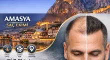 Amasya Saç Ekimi